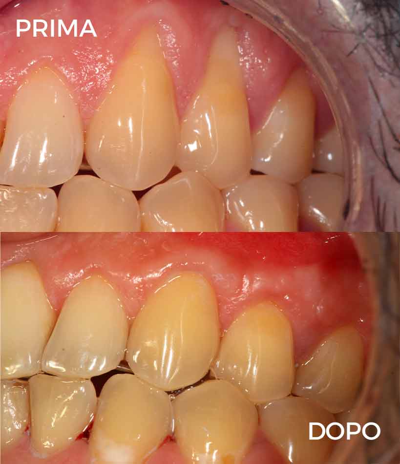prima e dopo mattioda