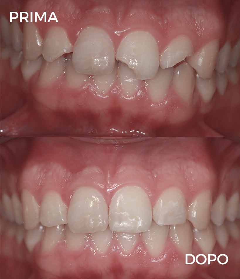 prima e dopo mattioda